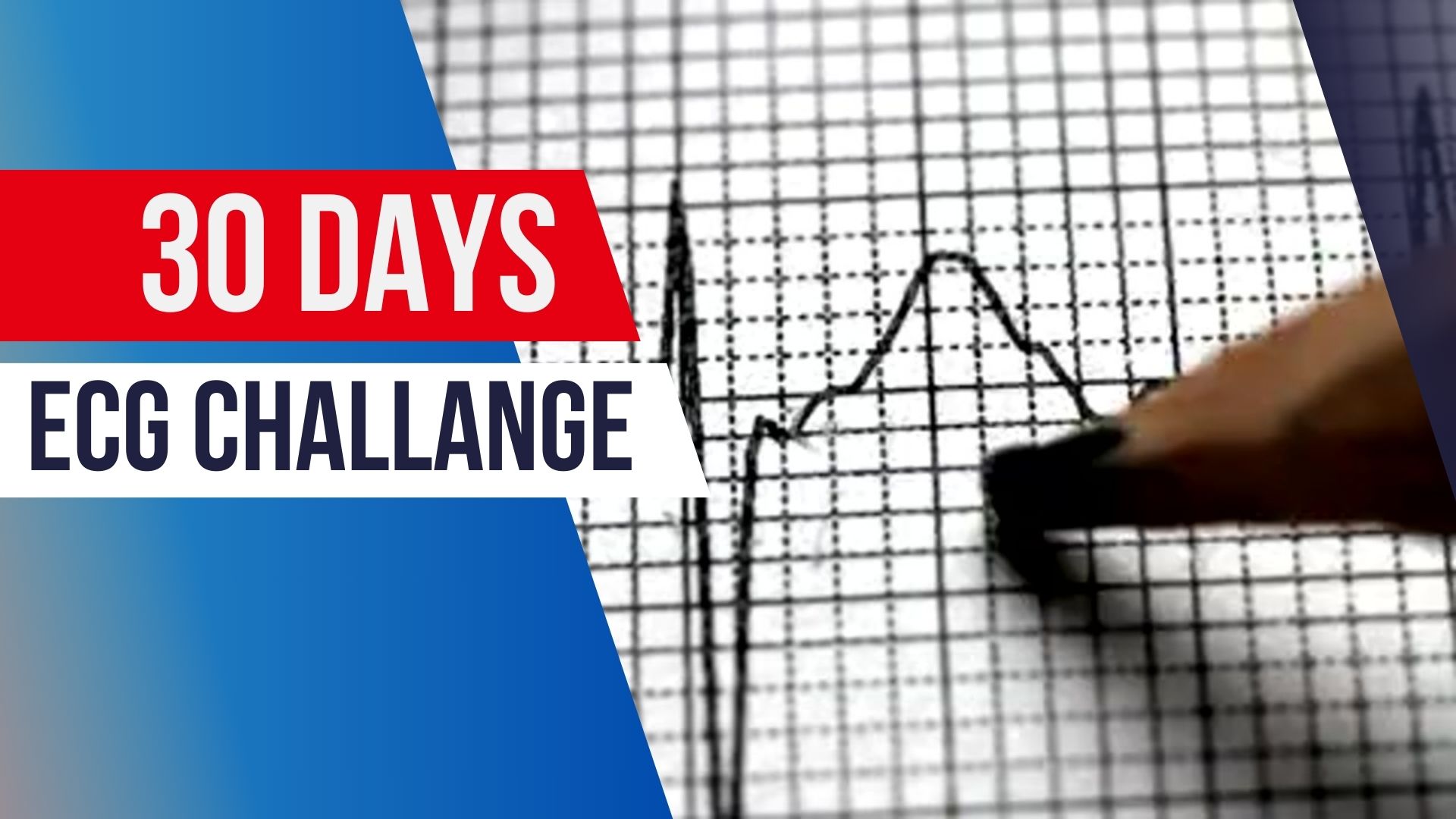 30-Day ECG Challenge ✅: Clinical Skills Development Program