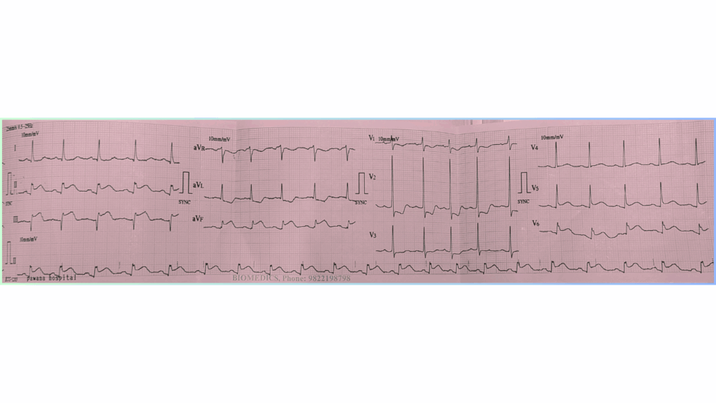 Inferior STEMI ECG