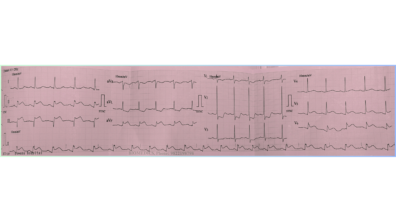 Inferior STEMI ECG