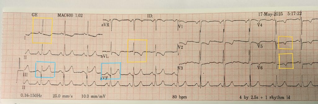 Inferior STEMI ECG with reciprocal changes