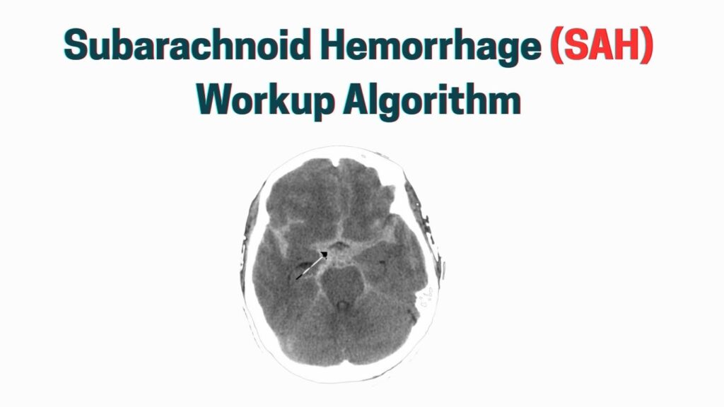 Subarachnoid Hemorrhage Workup Algorithm