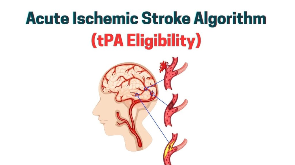 Acute Ischemic Stroke Algorithm